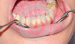 Hypoplasia of tooth enamel photo