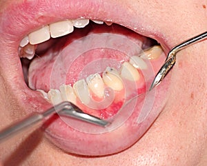 Hypoplasia of tooth enamel photo