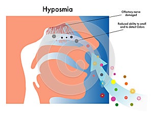 Hyposmia