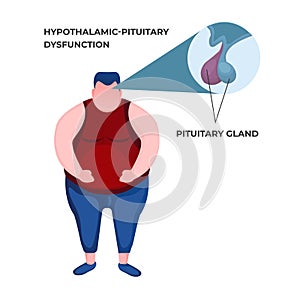 Hypothalamic dysfunction. Illustration of the obese boy and pituitry gland