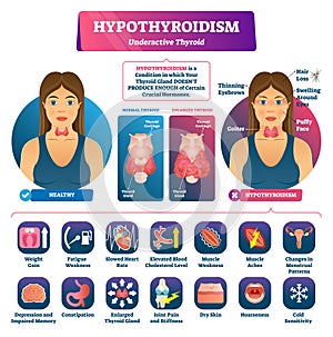 Hypothyroidism vector illustration. Labeled underactive thyroid explanation