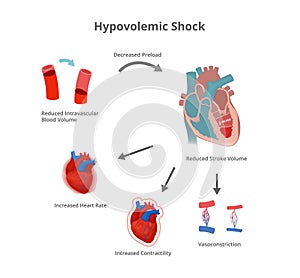 Hypovolemic shock pathology. Compensatory mechanisms of hypovolemic shock