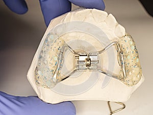 Hyrax braces wear on patient teeth gypsum model