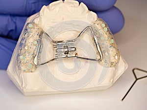 Hyrax braces wear on patient teeth gypsum model