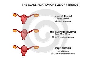 Hysteromyoma, uterine myoma photo