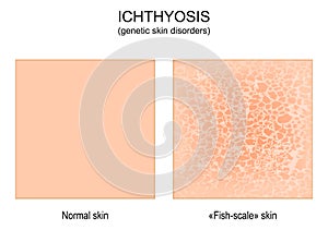Ichthyosis. genetic skin disorders. Normal and skin of a person with ichthyosis