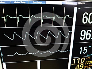 ICU Monitor Screen Showing Pacemaker Spikes on Top Tracing