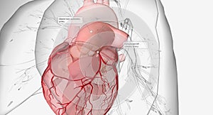 Idiopathic Dilatation of Pulmonary Artery