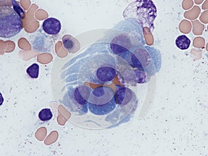 IgA multiple myeloma, bone marrow.