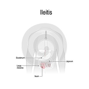 Ileitis is an inflammation. Part of the small intestine