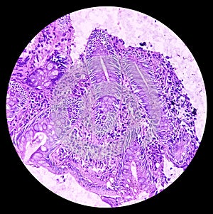 Ileo-cecal ulcer (biopsy): Chronic nonspecific ileitis. IBD. photo