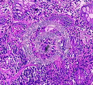 Chronic nonspecific ileitis with ulcer. Section show ileal mucosa, plasma cell in lamina propria. IBD. photo