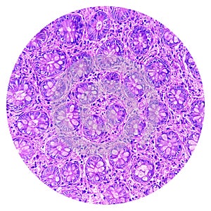 Ileo-cecal ulcer (biopsy): Chronic nonspecific ileitis with ulcer. Section show ileal mucosa. photo