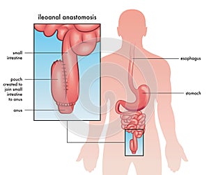 Ileoanal anastomosis