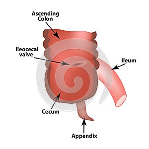 Ileocecal angle. Ileocecal valve. Bauginiev s damper. The ileum, the Cecum, the Apendix. Colon. Infographics. Vector illustration photo