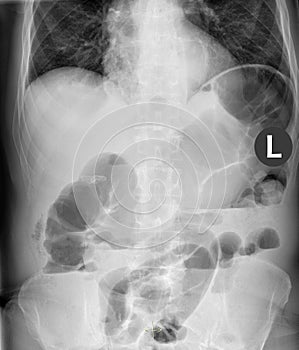 Ileus