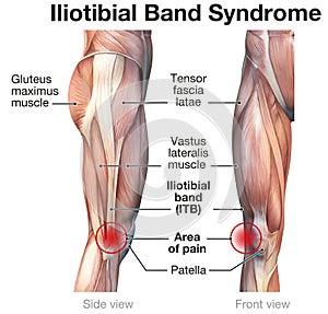 Iliotibial band syndrome, painful knee joint. Labeled Illustration