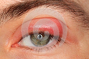 Illness person eye with sty and pus photo