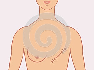 Illustrated mastectomy