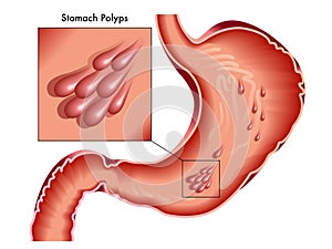 Illustrated stomach polyps