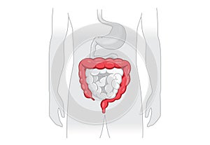 Illustration about abnormal symptom of human large Intestine.