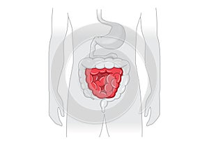 Illustration about abnormal symptom of human small Intestines.