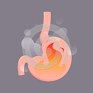 Illustration from acid reflux or heartburn