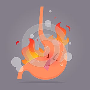 Illustration from acid reflux or heartburn
