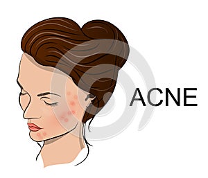 Illustration of acne