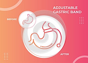 Illustration of Adjustable Gastric Band devise Weight Loss Surgery vector