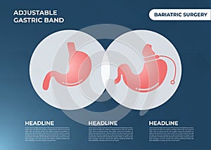 Illustration of Adjustable Gastric Band devise Weight Loss Surgery vector