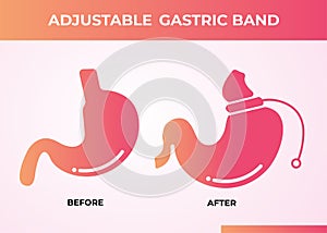 Illustration of Adjustable Gastric Band devise Weight Loss Surgery vector