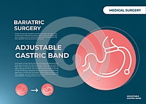 Illustration of Adjustable Gastric Band devise Weight Loss Surgery vector
