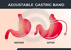 Illustration of Adjustable Gastric Band devise Weight Loss Surgery vector