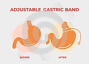 Illustration of Adjustable Gastric Band devise Weight Loss Surgery vector