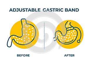 Illustration of Adjustable Gastric Band devise Weight Loss Surgery vector