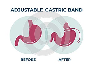 Illustration of Adjustable Gastric Band devise Weight Loss Surgery vector