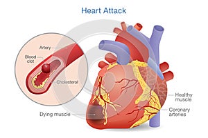 Illustration of Arterial thrombosis is a blood clot that develops to heart attack.