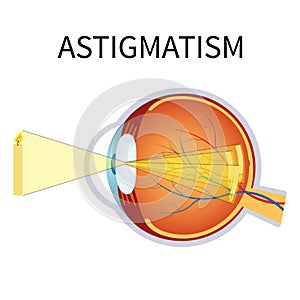 Illustration of astigmatism. photo