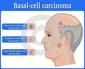 Illustration of Basal cell carcinoma