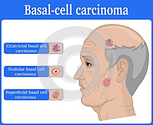 Illustration of Basal cell carcinoma photo