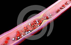 Illustration of blood cells with plaque buildup of cholesterol isolated black background Cholesterol plaque in artery