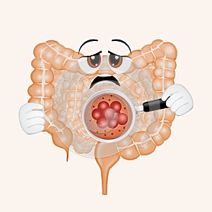 Illustration of bowel cancer