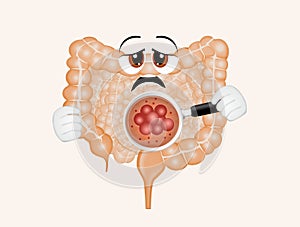 Illustration of bowel cancer