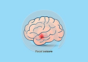 Illustration of brain and abnormal brain waves