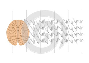 Illustration of brain and generalized sharp waves