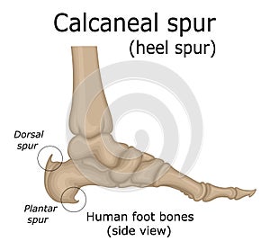 Illustration of Calcaneal spur photo