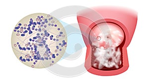 Illustration of a candidiasis infection on the cervix. Vaginal Candidiasis. Candida albicans this infection is also photo
