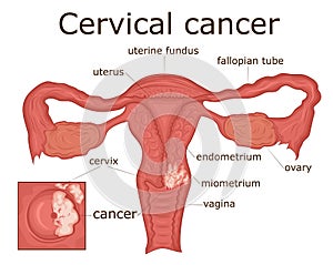 Illustration of cervical cancer