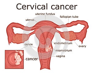 Illustration of cervical cancer photo